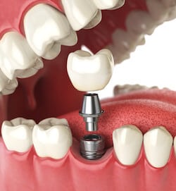 3d illustration Tooth human implant 